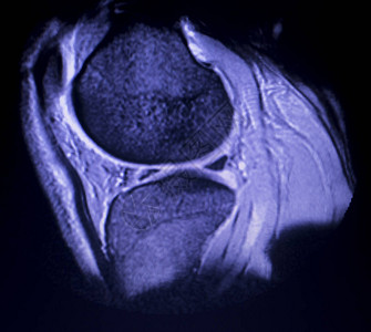 磁共振成像MRI膝盖后部角中枢断裂的眼泪图片