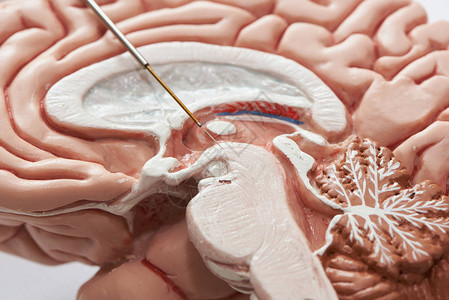 大脑模型上微电极记录的特写视图帕金森病手术中丘脑底核图片