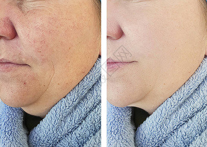 女人在手术前后脸上的皱纹酒渣鼻图片