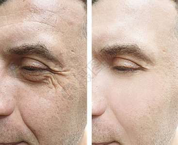 人脸皱纹治疗前后图片