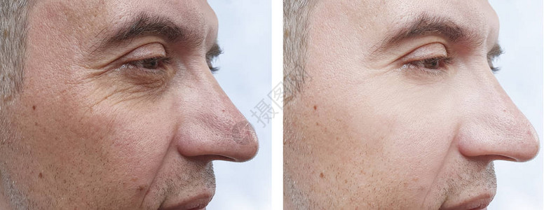 人脸皱纹治疗前后图片