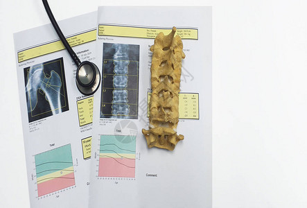 顶视图骨密度和腰椎结果骨质疏松症骨质疏松症是一种削弱骨骼的情况图片