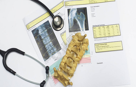 顶视图骨密度和腰椎结果骨质疏松症骨质疏松症是一种削弱骨骼的情况图片
