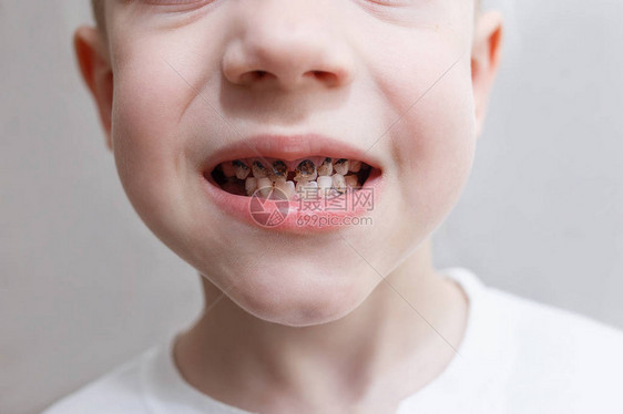 保健牙科卫生和童年概念牙科问题在中背景上孤立无援的男孩子牙缝图片