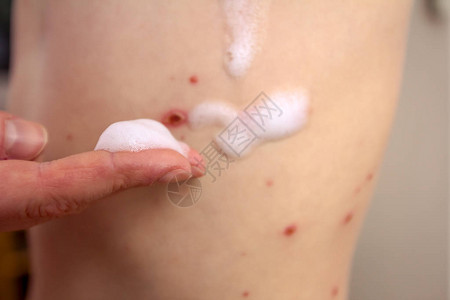 受天花感染的儿童皮肤正在使用抗消毒图片素材