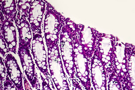 细菌痢疾光学显微照片显微镜下照片显示细菌的存在和炎图片