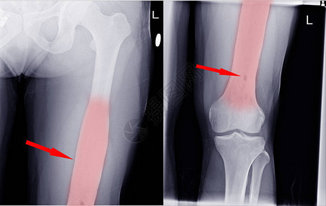 Knee关节Small淋巴病图片