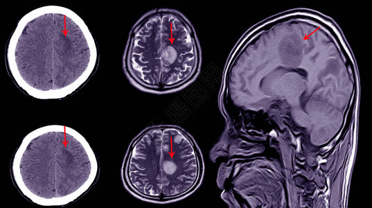 对有轻微头部损伤历史的病人进行CT脑扫描图片