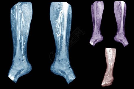 CTALeg3D左腿肝血管外科下端的计算机断层成像摄影CT血管图片