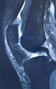 膝部运动受伤米克2级撕裂磁共振成像矫图片