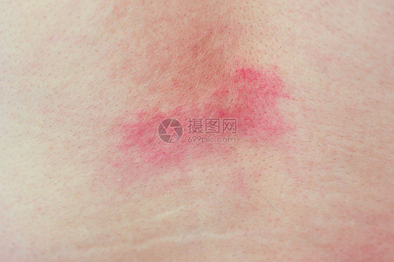 成年男皮肤刺激和过敏甲状腺炎或乙型Ecz图片