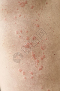 皮肤瑕疵皮肤过敏荨麻疹病皮肤上背景图片