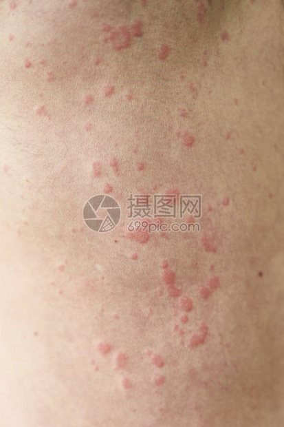 皮肤瑕疵皮肤过敏荨麻疹病皮肤上图片