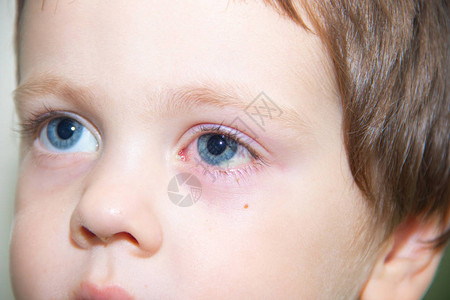 儿童眼结膜炎眼科疾病红眼睛血管在眼中爆图片