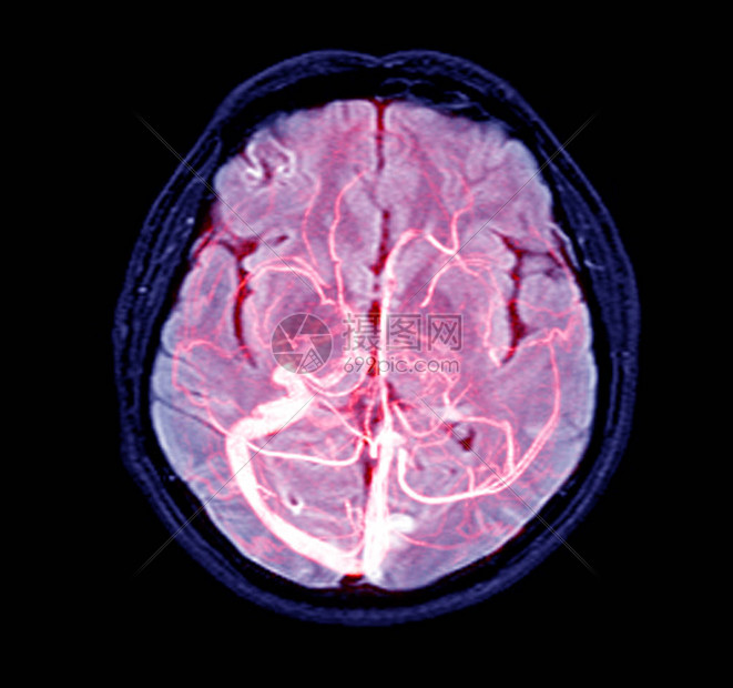 人头血管脑部的电磁共振脉动MRV可能是多次出血脑转移或出血的洞穴瘤图片