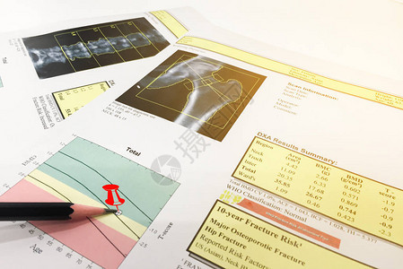 Hip和SpineBone矿藏密度BMDDEXA时空测距扫描Osteopenia存在图片