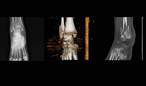 X射线和CT扫描钻井脚踝显示断裂纤维骨螺旋骨折图片
