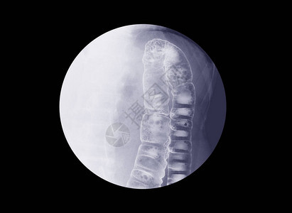 钡灌肠检查点片下消化背景图片