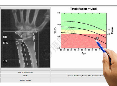 白背景的骨髓矿物密度Osteoporisod症图片