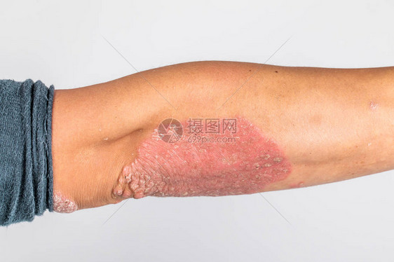 患有粗俗的牛皮癣湿疹和其他皮肤病图片