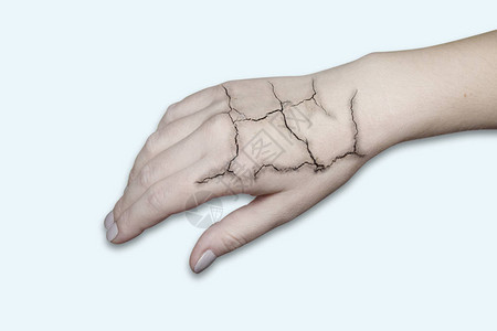 皮肤裂开的手皮肤皲裂皮肤干燥冬季护图片