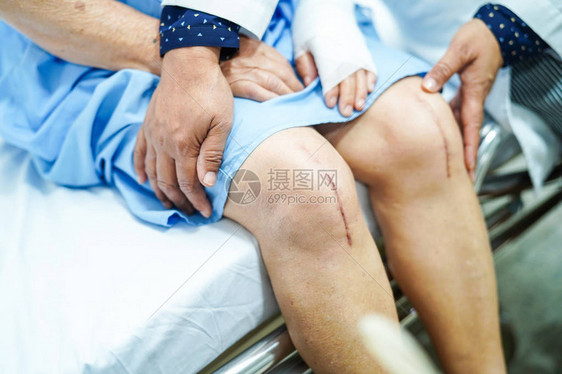 亚洲老年或老年妇人患者在护理医院病房的床上展示她的疤痕手术全膝关节置换缝合伤口手术关节成形术图片