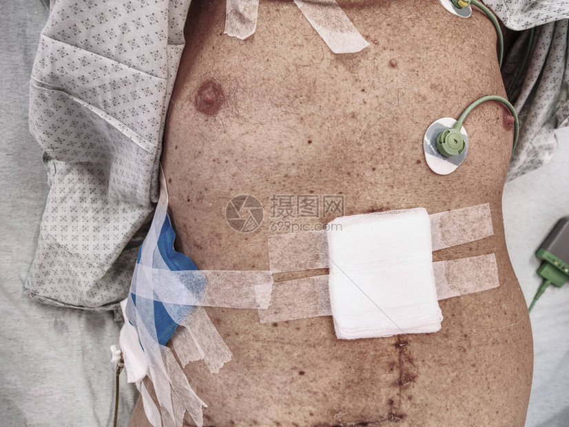 病人躺在医院的床上时腹部显示有新的伤疤图片