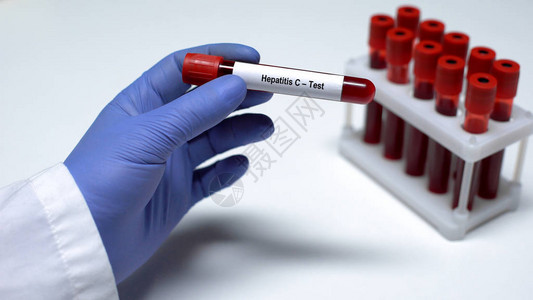 C型肝炎在输血管中验血实验室研究健图片