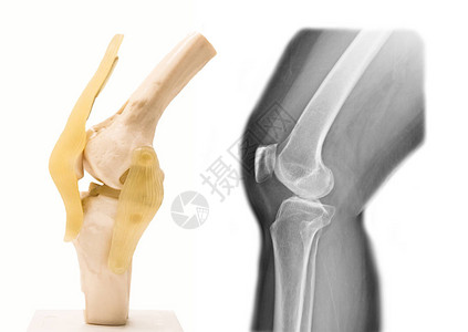 医学上人工膝盖结关模型和图片