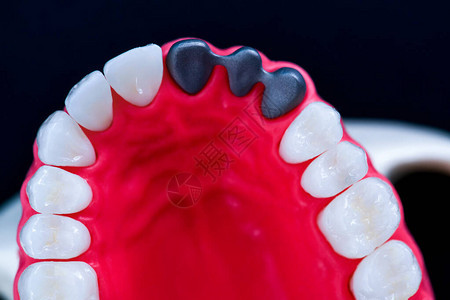 在蓝色背景上隔离的牙齿植入和冠安装过程医学精确的图片