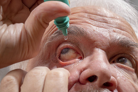 青光眼患者自行滴眼药水一位患有图片