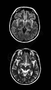 黑色大脑MRI扫描图片