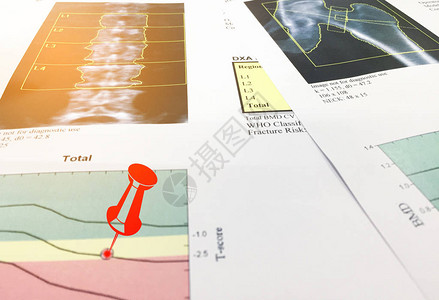 Hip和SpineBone矿藏密度BMDDEXA时空测距扫描Osteopenia存在图片