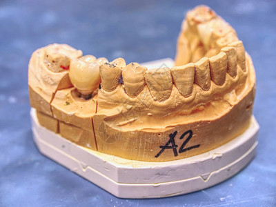 牙科实验室石膏模型上的人牙陶瓷和锆冠牙冠修复的图片