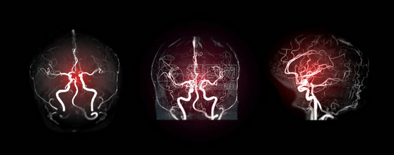 收集脑部动脉的MRA大脑或磁共振血管图像MRA图片