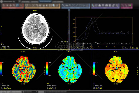 脑部的CT扫描图像3D在屏幕监视器上图片