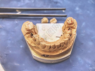 半加工中的假牙人造牙修复体手工制作的现代牙科陶瓷植入物的测试图片