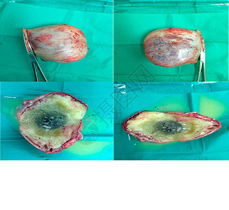 近距离接近OvarianCystectomy一个45岁的女找到了有空间的DermoidCystMedic图片