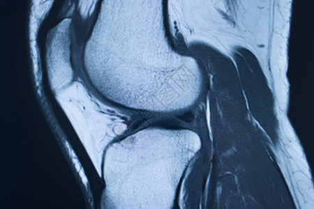 膝部运动受伤米克2级撕裂磁共振成像矫图片