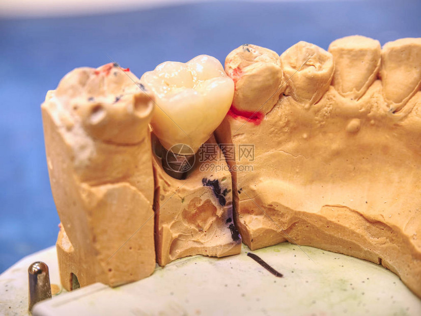 牙科实验室石膏模型上的人牙陶瓷和锆冠牙冠修复的图片