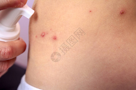 皮肤消毒图片