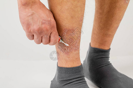 对腿部的过敏皮疹施用治疗药膏图片素材