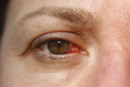 感染结膜炎或流感后感冒或过敏的女血液和健康眼部紧贴着一种烦躁的红血图片