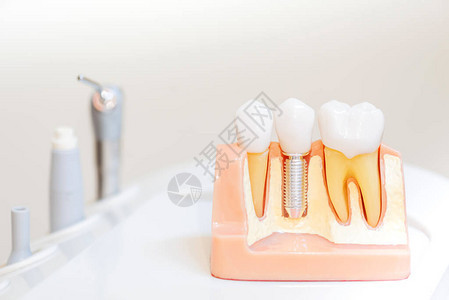 牙齿植入假牙科诊所的牙科和图片