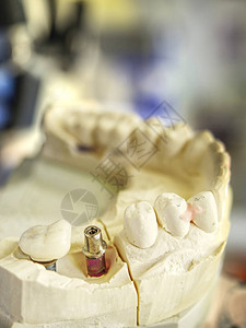 在牙医颌骨模型上制作假牙原型图片