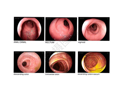 结肠镜检查肛管直肠乙状结肠降结肠横结肠升结肠盲肠正常图片