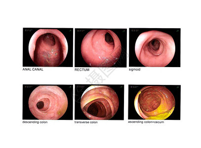 结肠镜检查肛管直肠乙状结肠降结肠横结肠升结肠盲肠正常背景图片