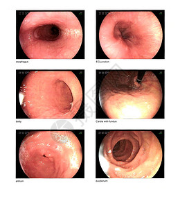 医学图像胃肠道内分泌检查图象EGD食道透视在食背景图片