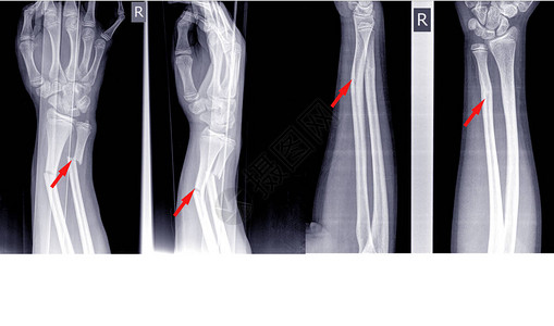 手腕关节右侧X射线图像图片
