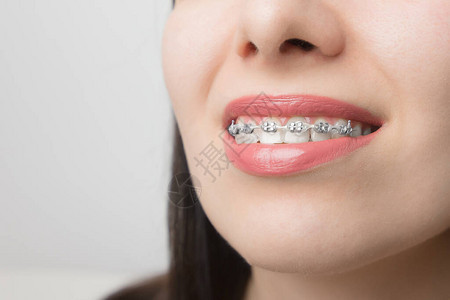 年轻女子微笑着戴牙套美白后牙齿上的支架带金属系带和灰色松紧带或橡皮筋的自锁式托槽图片